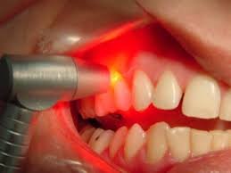 laser hipersensibilidade